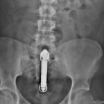 vibrator_a_fenekeben_RTG_felvetel